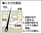 にきびの原因｜男性化粧品・メンズコスメ通販のザス-zas