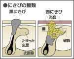 にきびの種類｜男性化粧品・メンズコスメ通販のザス-zas