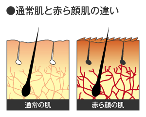 通常肌と赤ら顔肌の違い