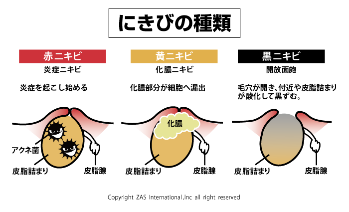 治ら 赤い ない ニキビ