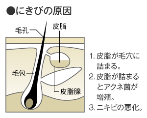 にきびの原因