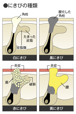 にきびの種類